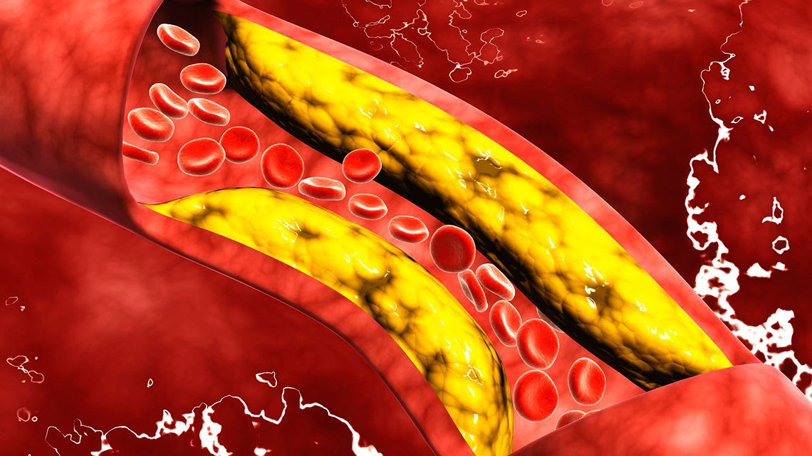 Colesterol: Sintomas, Tratamentos E Causas. - Quality Medicina E ...